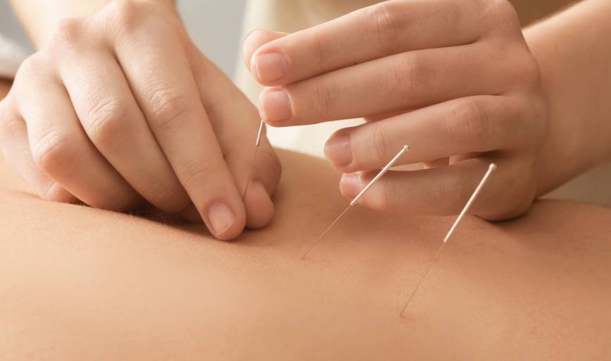 Acupuncture